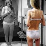 anoressia e bulimia